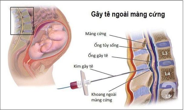 GIẢM ĐAU TRONG ĐẺ TẠI BỆNH VIỆN PHỤ SẢN NAM ĐỊNH