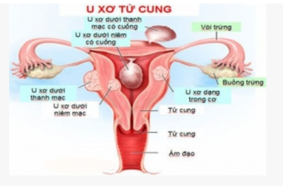 U XƠ TỬ CUNG