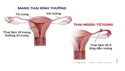 THAI NGOÀI TƯ CUNG: CHUẨN ĐOÁN VÀ ĐIỀU TRỊ SỚM